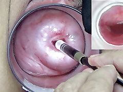 A endoscope chinese camera is inserted in the cervix to watch inwards the uterus.