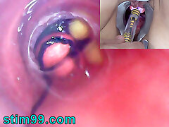 Mature Dame, Peehole Endoscope Camera in Bladder with Balls
