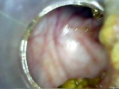 głęboki głęboki anal ponownie strona główna kolonoskopia endoskopu część 1