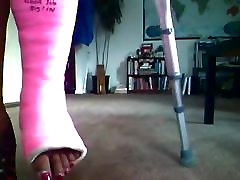 cast fetish - broken ankle