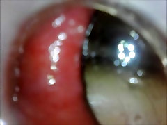 anal endoscope ass play from inside anal endoscope ass play from inside