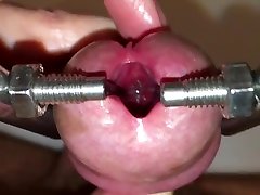 urethral stretching with super device