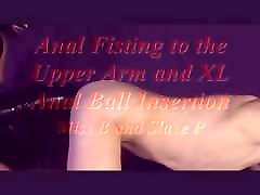 Anal Fisting to the Upper Arm and XL sexy teacher blackmail bondage Ball Insertion