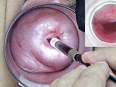 A endoscope asian camera is inserted in the cervix to observe inside the uterus.