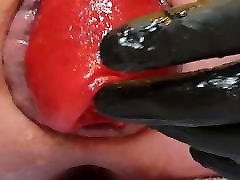 More prolapse