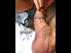 pre circumcision revision redo