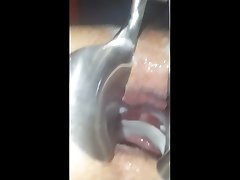 speculum gape cum fill
